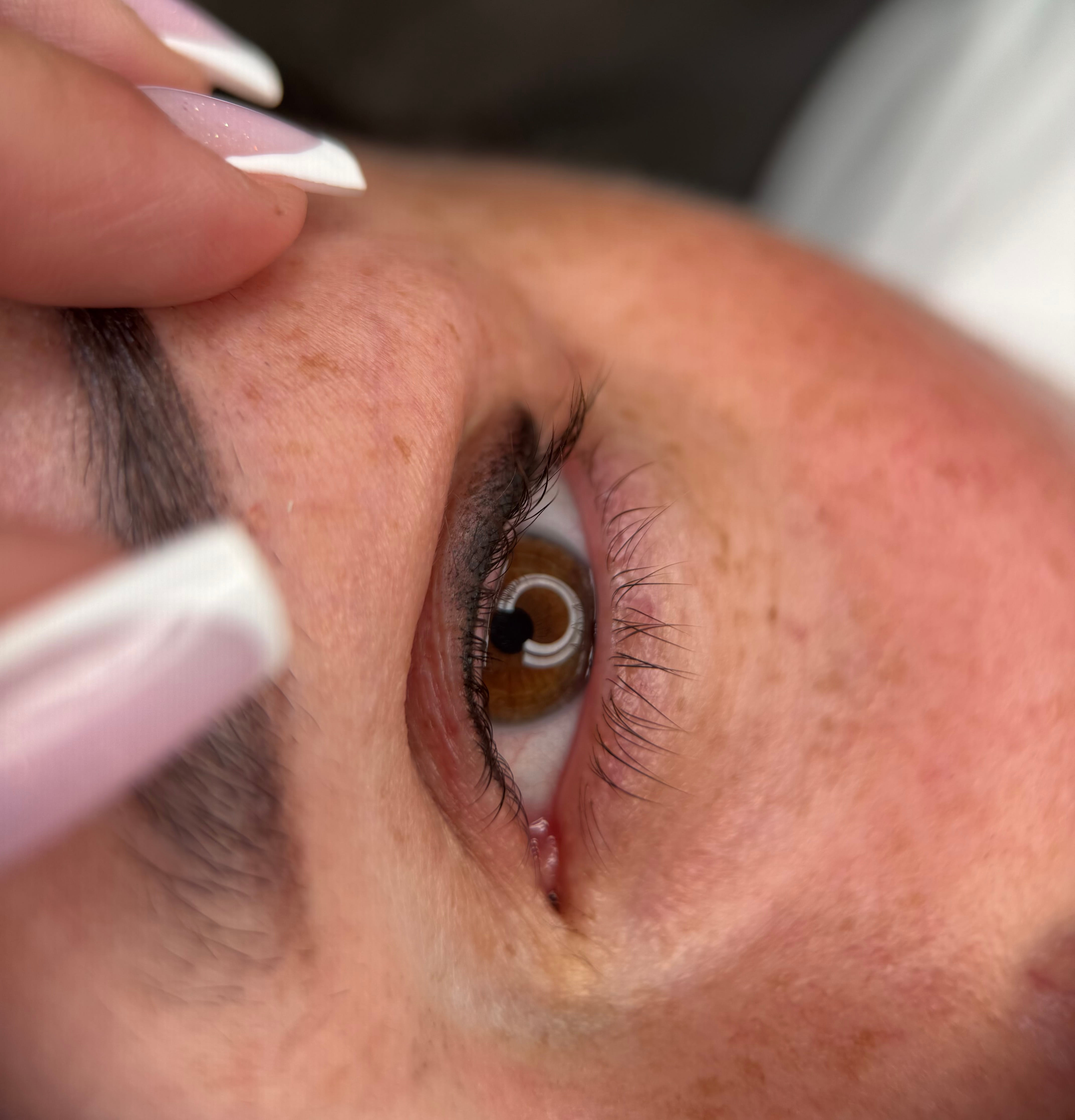 Softliner & Wimpernkranzverdichtung Ergebnis